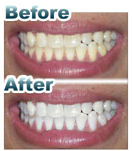 teeth whitening before and after metairie la