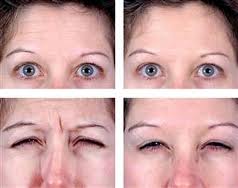 Botox Injection Before and After Metairie, LA